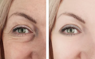 Indiba facial antes y después: resultados visibles desde la primera sesión