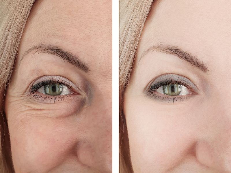 Indiba facial antes y después: resultados visibles desde la primera sesión