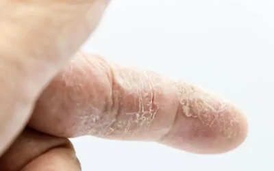 Piel seca:¿por qué en verano la piel se deshidrata más de lo que parece?