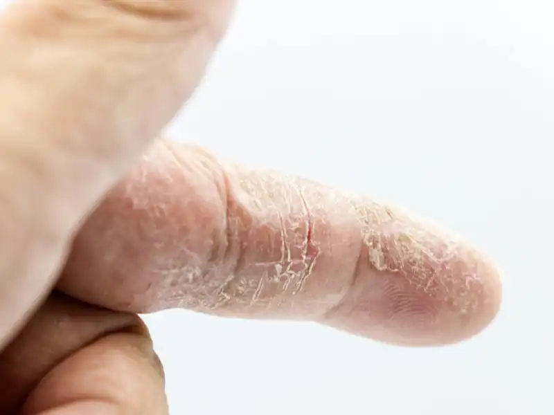 Piel seca:¿por qué en verano la piel se deshidrata más de lo que parece?