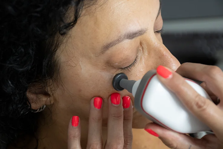 Tratamiento facial con radiofrecuencia para rejuvenecimiento del contorno de ojos